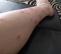 Image result for Fly Bite