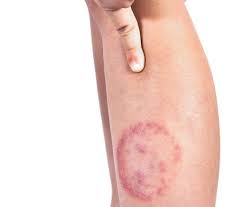 Image result for Skin Infection
