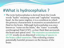 Hydrocephalus In 2020 Medical Knowledge Brain Surgery Recovery Childhood Health