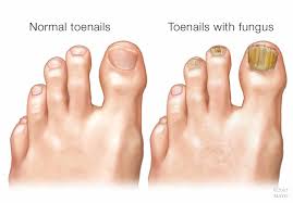 mayo clinic q and a toenail fungus