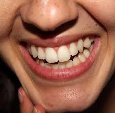 What Are Those White Spots On My Teeth