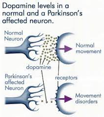 Parkinson's disease is a progressive nervous system disorder that affects movement. 3 Causes Of Parkinson S Disease Atrain Education