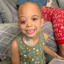 I was told my son's sore eye was just hay fever