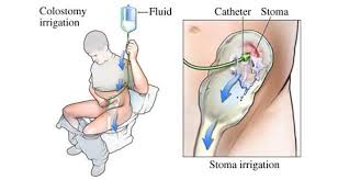 Colostomy Irrigation Nursing Procedure And Interventions