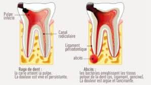 Une rage de dents est une inflammation de la pulpe très douloureuse et arrive toujours au mauvais moment. Rage De Dent Soigner Avec Des Produits Naturels