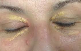 Image result for xantelasma