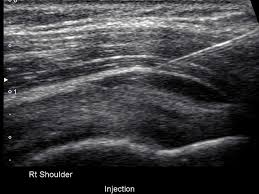 Image result for Subacromial Space Injection