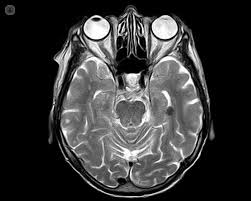 Risonanza Magnetica Cerebrale Che Cos E Sintomi Cause Prevenzione E Trattamento Top Doctors