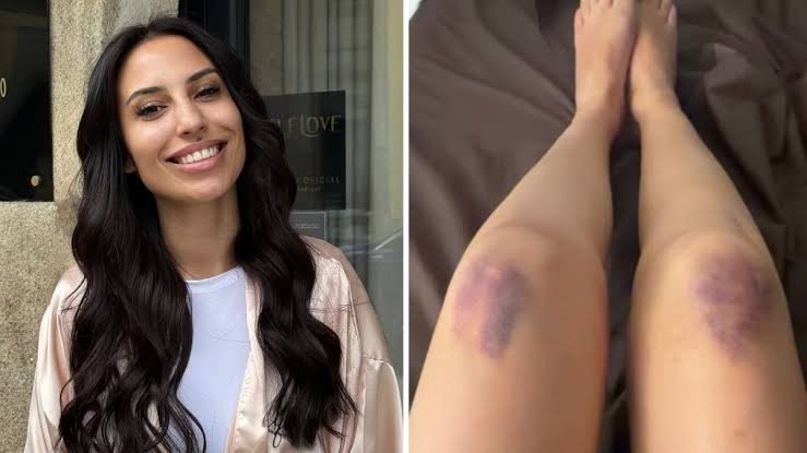 Catarina Miranda revela os hematomas após intensa sessão de kickboxing e admite: “Ainda vão ficar pior…”