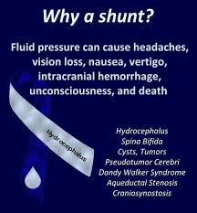 Pin On Hydrocephalus