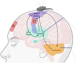 Image result for Thalamic Stimulation