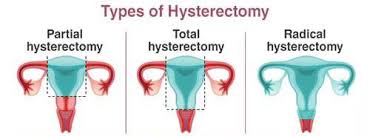 Cervical cancer cells can spread by breaking away from the cervical tumor. Sex After Hysterectomy Everything You Need To Know About It Theasianparent