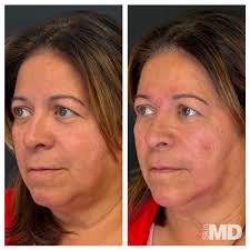 TOP 10 BEST Botox in Lexington, MA