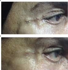 We did not find results for: Early Fractional Carbon Dioxide Laser Intervention For Postsurgical Sc Ccid