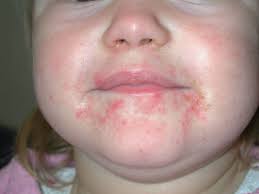 Image result for yellow scabs on the face in children