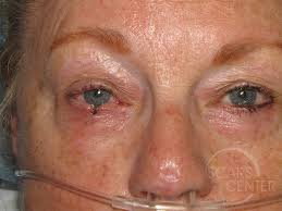 Basal cell carcinoma is more common in patients with fair skin, especially after prolonged sun exposure, frequent tanning, and other risk factors. Eyelid Reconstruction 3 Skin Cancer And Reconstructive Surgery Center