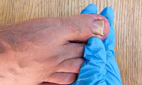 Image result for Paronychia feet