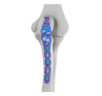 VAL Olecranon Locking Plate,Medical Device Manufacturers ...