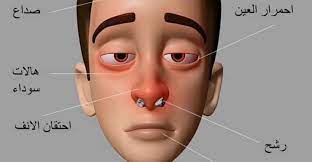 علاج حساسية الانف اعراض حساسية الانف علاج الحساسية التفاصيل حساسية الانف حساسية الانف المزمنة هي عبارة عن رد فعل تحسسي movie posters movies poster