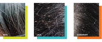Image result for lice vs dandruff