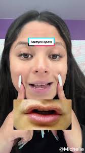 How to Remove Fordyce Spots under Eyes