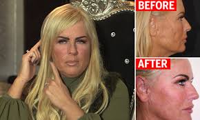 Former glamour model looks like she's been knifed after botched facelift