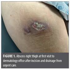 Image result for Skin Abscess