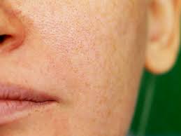 Laser Genesis The Ultimate Way To Minimize Pores Vein Laser Institute