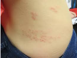 Image result for shingles in children