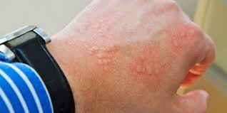 Image result for erysipel photos)