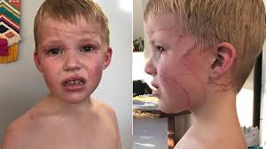 NSW news: Kangaroo mauls five-year-old boy in northern NSW as drought  continues