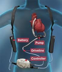 Watch a video for a demonstration of the cusp overlap technique for aortic stenosis. Left Ventricular Assist Devices Acmc Em