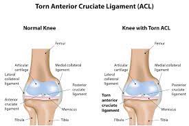 The anterior cruciate ligament (acl) is one of the 4 major ligaments of the knee. How Do You Know If You Tore Your Acl Orthony