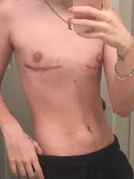 I have keloid in the same place on chest and another one on back. Despite My Keloid Scars I Still Love My Chest Remember That Dark And Thick Scars Are Beautiful Too Having Very Visible Ones Doesn T Make You Less Of A Man Ftm