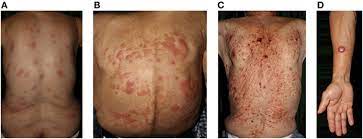 Lymphoma is a cancer that occurs when your body's white blood cells, called lymphocytes, begin behaving abnormally. Frontiers New Therapies And Immunological Findings In Cutaneous T Cell Lymphoma Oncology