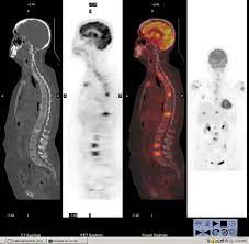 By capturing images of bones on a computer, bone scans may reveal important information. Detection Of Bone Metastases In Breast Cancer Patients In The Pet Ct Era Do We Still Need The Bone Scan Sciencedirect
