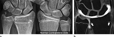 Growth Plate Closure In A 13 Year Old Girl 1 Year After A