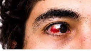 Blood In The Eye Consumer Health News Healthday