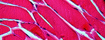 Inclusion Body Myositis Johns Hopkins Medicine
