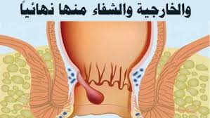 البواسير الخارجية بالشرح والصور مجلة رجيم