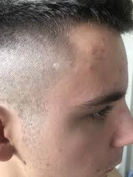 Check out our spot on head selection for the very best in unique or custom, handmade pieces from our shops. M21 Noticed This White Spot On My Scalp As I Got Shorter Haircut Could It Be Some Sort Of Melanoma Melanoma