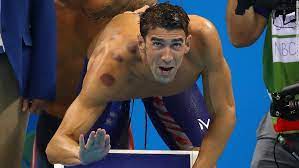 Olympics In Bright Red Spots What Is Cupping Cnn