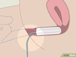 Learn the parts of a tampon, where it goes inside your body, and how to insert a tampon with an applicator. How To Insert A Tampon Without Applicator With Pictures