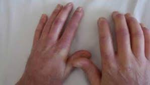 Ellerde Ve Kollarda Morarma Nedenleri Acil Servis