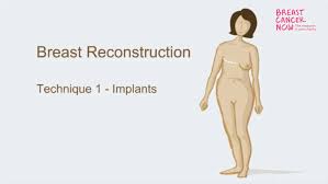 Types Of Breast Reconstruction Breast Cancer Now