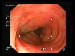 Maybe you would like to learn more about one of these? Clostridium Difficile Medtube Net