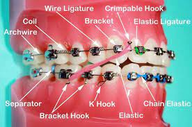 Braces #behel #pendakapgigi #kawatgigi pasang braces gigi atas dijamin murah dan berkualitas bagus. Nanyfadhly Pengalaman Memakai Braces Pada Usia 37 Tahun