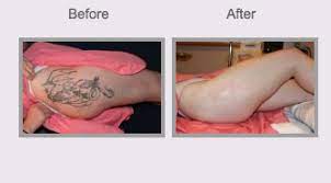 The cheapest method on how to remove a tattoo without laser done naturally at home. Laser Tattoo Removal Parsippany Troy Hills Weinstein Plastic Surgery