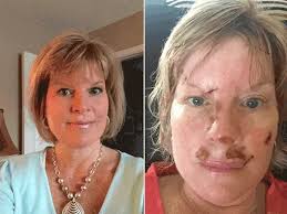 Mom of two shares graphic photos of her skin cancer battle to raise  awareness