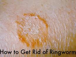 Mar 13, 2021 · funginix healthy nail formula uses a unique blend of ingredients to eliminate toenail fungus while healing the skin. How I Got Rid Of Ringworm Patient S Lounge